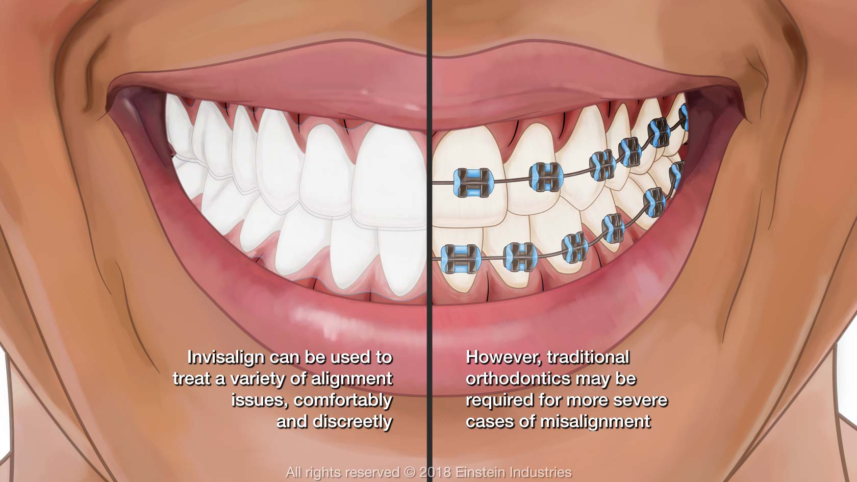 Diagram of teeth with and without braces